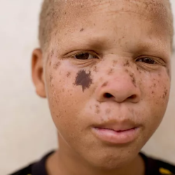 ONG Peacemakers for Albinism